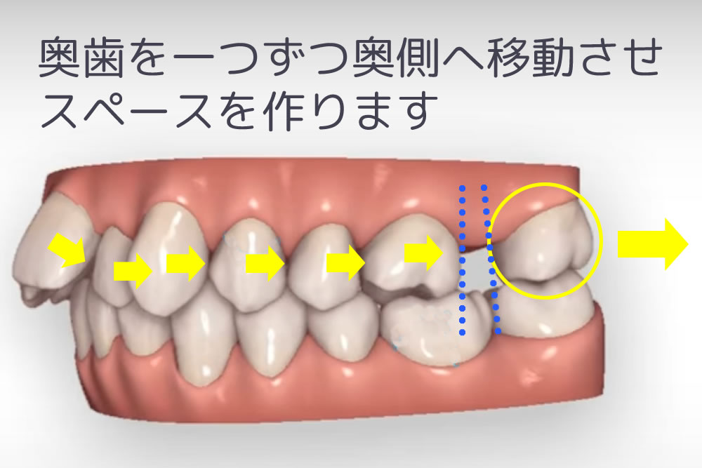 歯の遠心移動