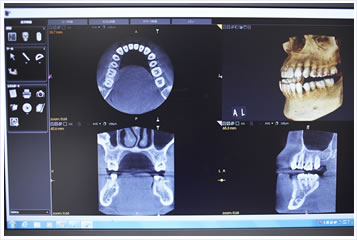 歯科用CT