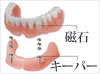 磁性アタッチメント義歯加工