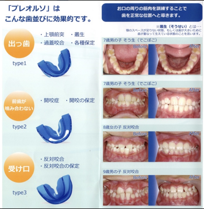 プレオルソ こども歯並び矯正法 篠崎 歯科 | 江戸川区篠崎の歯医者 ...