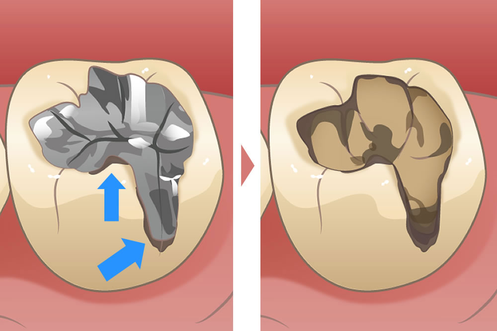 5年で再発する虫歯