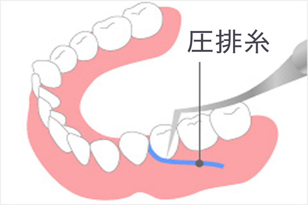 歯肉圧排