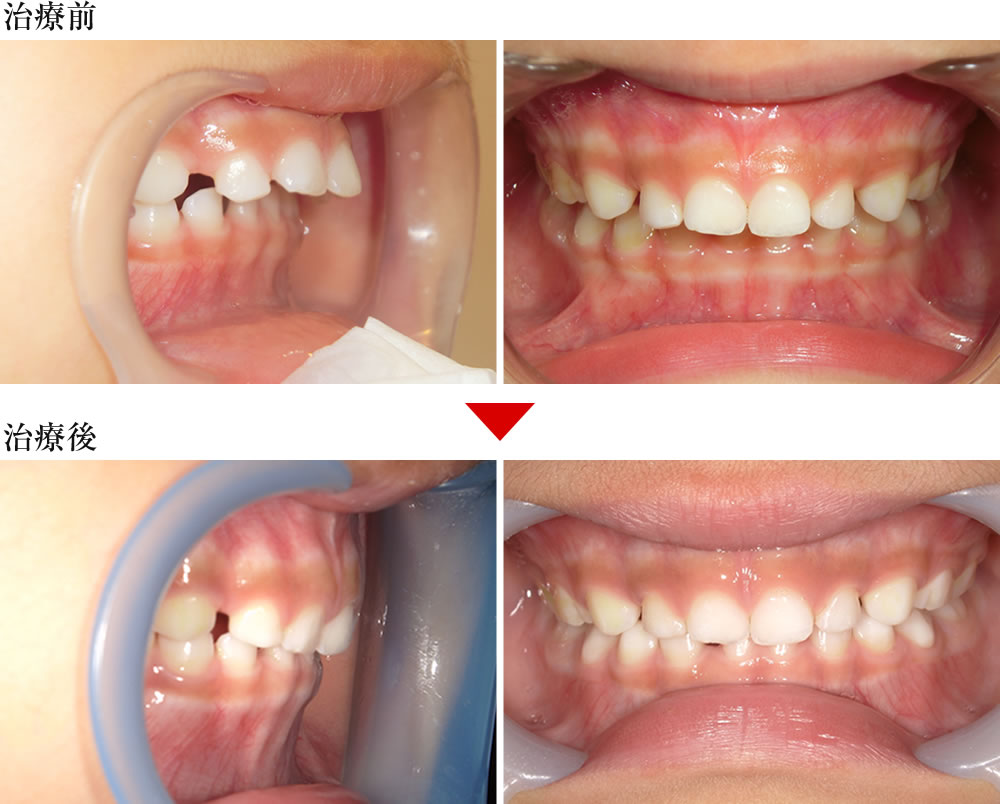 プレオルソ症例