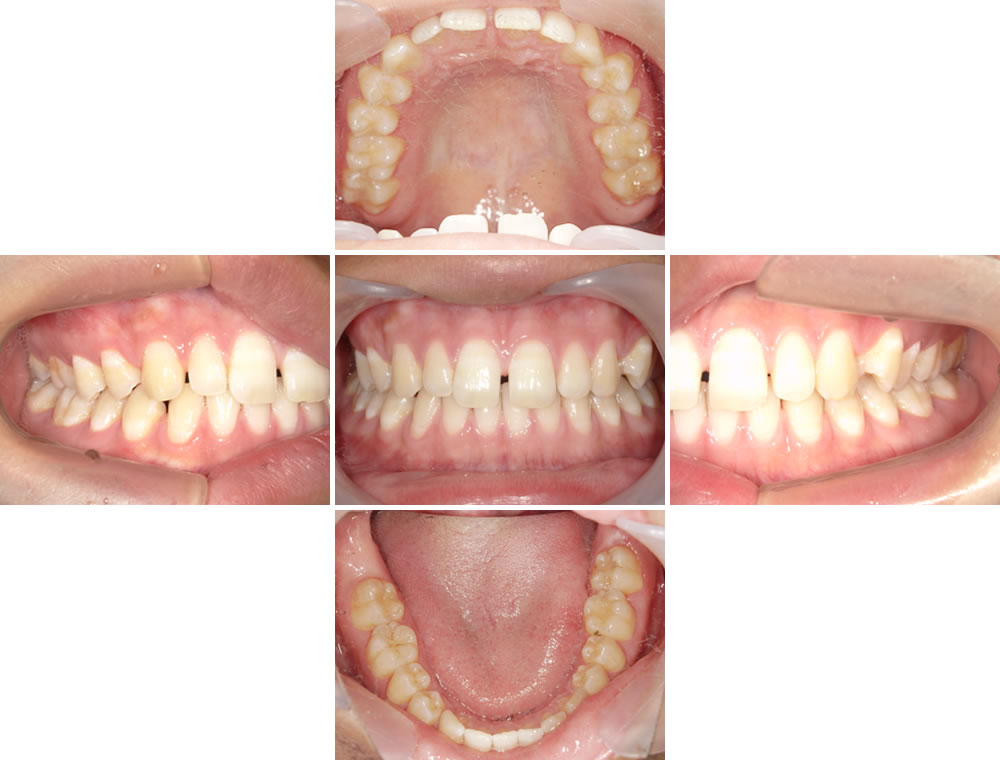 初診時の口腔内