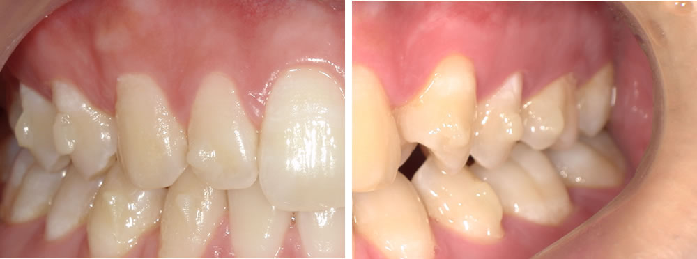 インビザラインGOによる矯正治療の開始