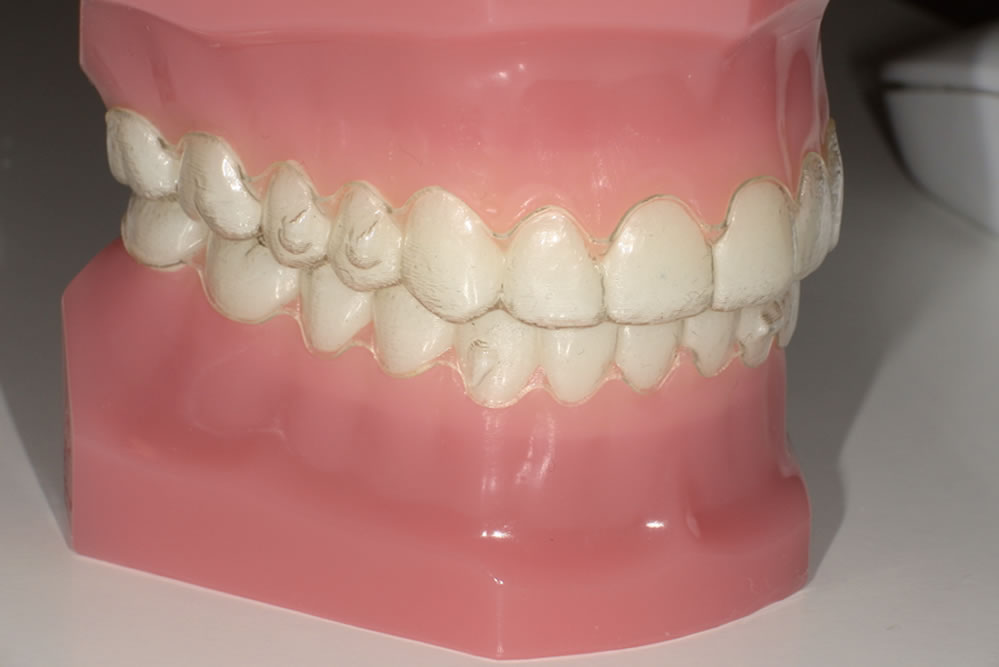 マウスピースのお渡し・矯正治療開始