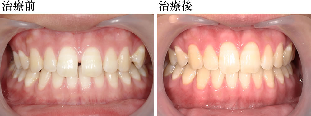 矯正治療前後の比較