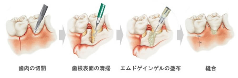 歯周外科